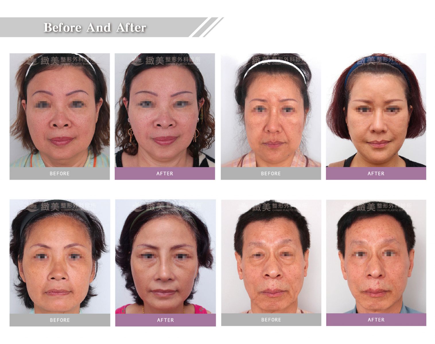 Facelift Surgery-緻美整形外科診所